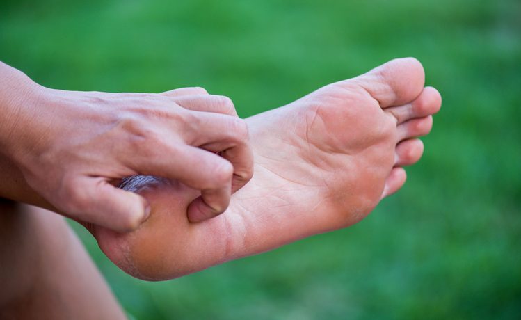 personne qui a de l'eczéma aux pieds